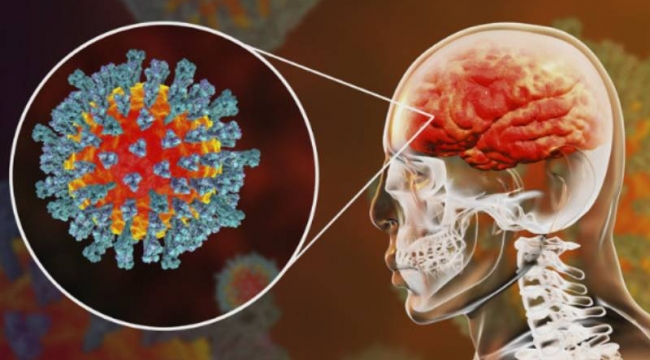 Covid-19 geçiren bazı beyinlerin 10 yıla kadar yaşlanabildiği, bazılarının da IQ seviyelerinin düştüğü anlaşılmış