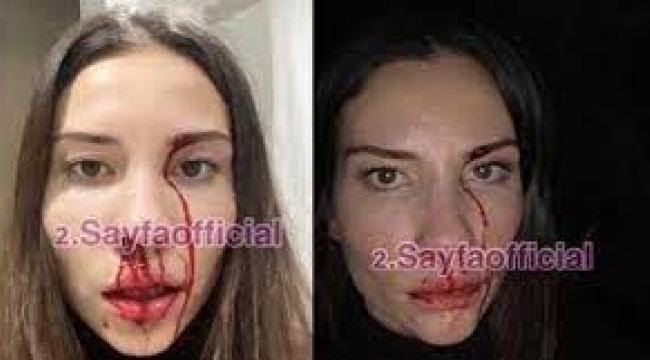 Futbolcu Özer Hurmacı'nın eşi Özer Hurmacı'dan darp iddiası