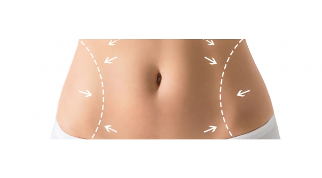 Karın Germe Ameliyatı (Abdominoplasty)