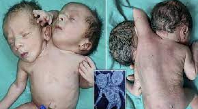 İki kafa ve üç kolla doğan bebekler şaşkına uğrattı...
