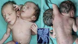 İki kafa ve üç kolla doğan bebekler şaşkına uğrattı...