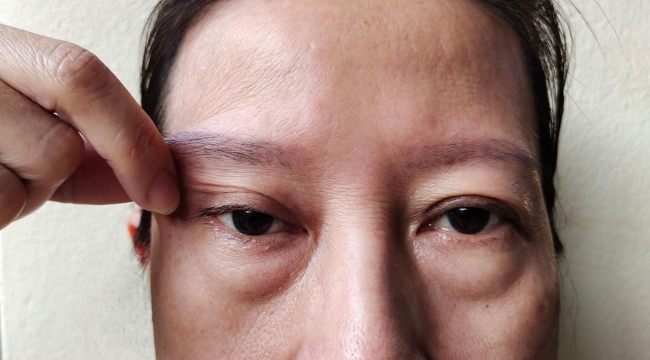 Göz Kapağı Düşüklüğü Ameliyatı