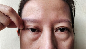 Göz Kapağı Düşüklüğü Ameliyatı