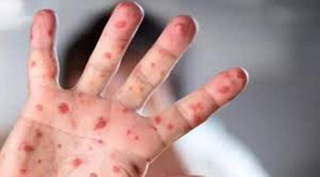 Yeni bir salgın kapıda mı? Mpox virüsü 13 ülkeye yayıldı!
