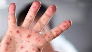Yeni bir salgın kapıda mı? Mpox virüsü 13 ülkeye yayıldı!