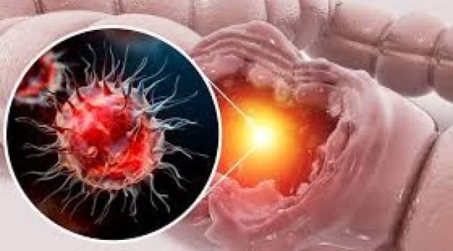 Kanser belirti vermeden yayılabilir mi? Sessizce gelişen 5 ölümcül kanser