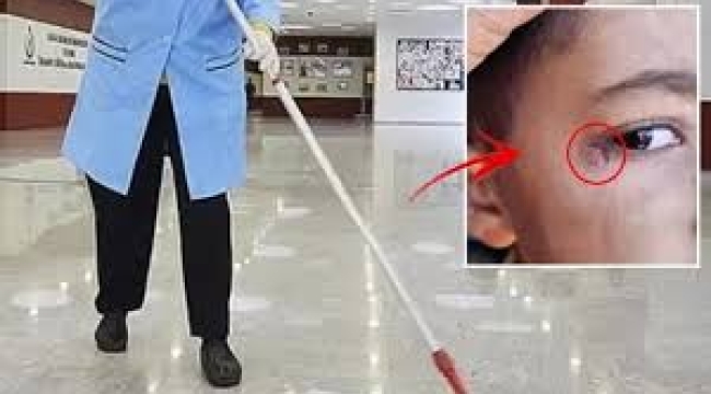 Temizlik görevlisi ilkokul öğrencisinin gözünde sigara söndürdü